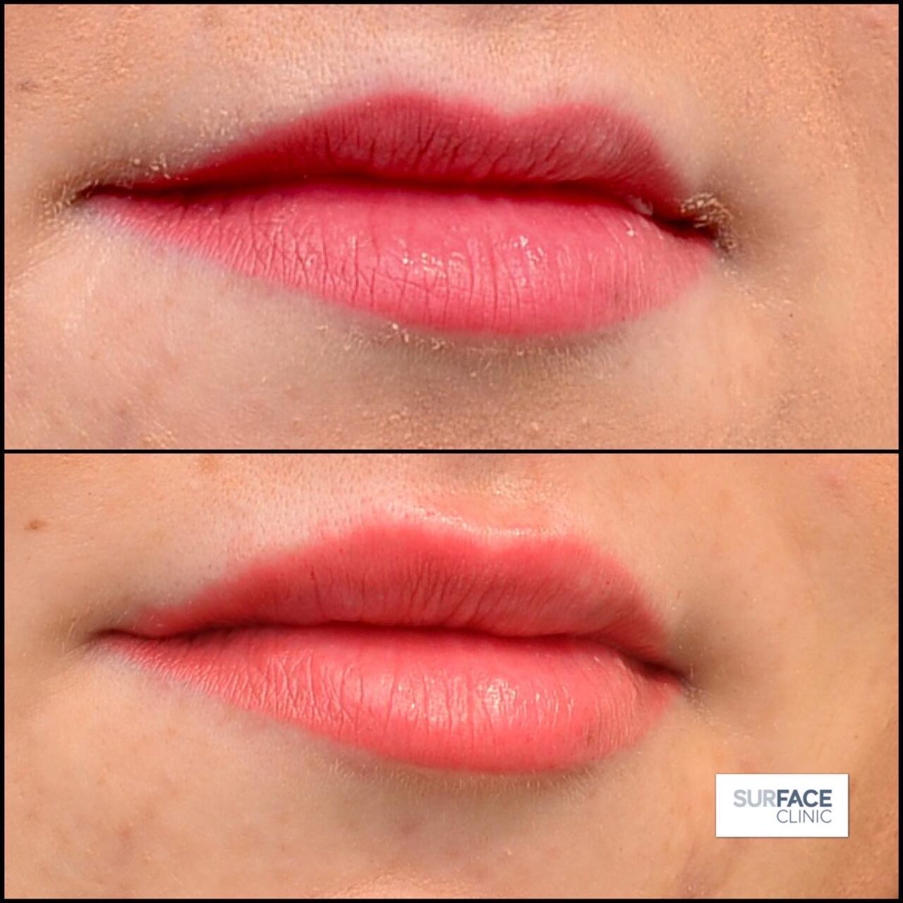 Lip filler Saltaire