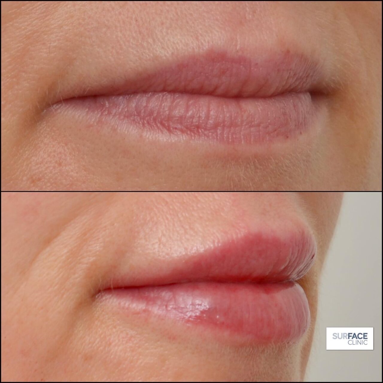Lip filler Bradford
