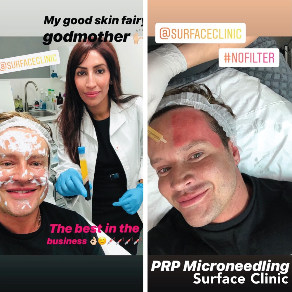 PRP Microneedling