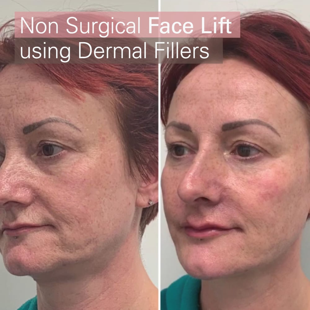 non surgical facelift