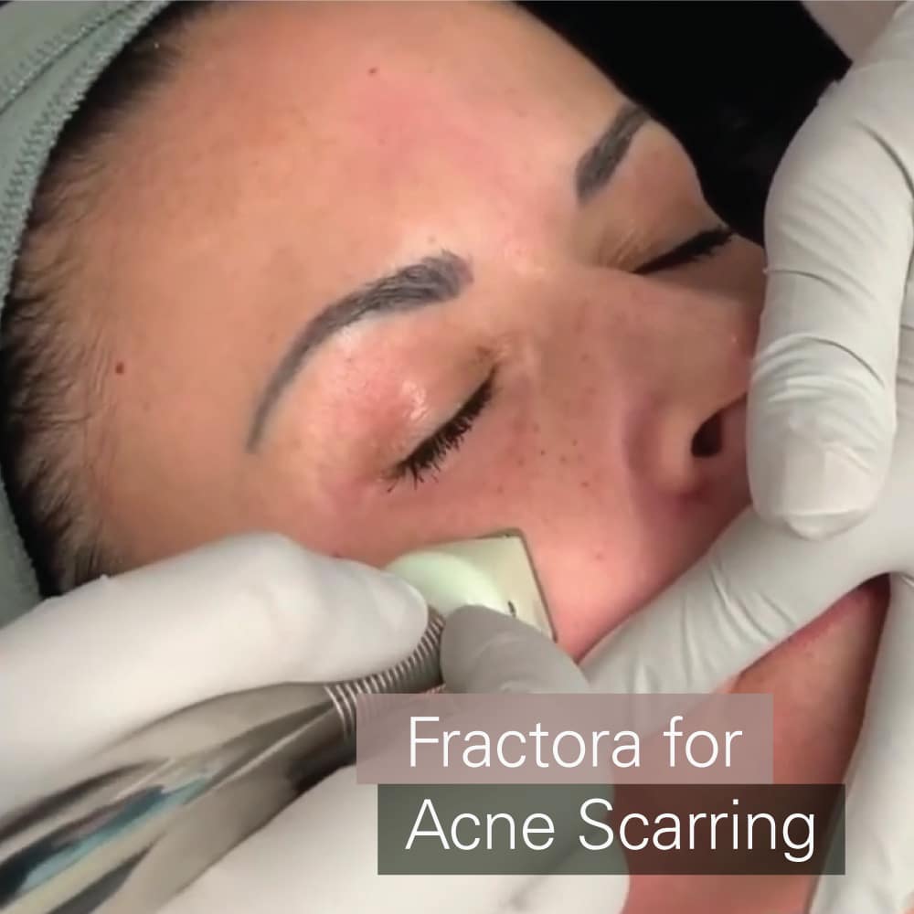 Scar treatment