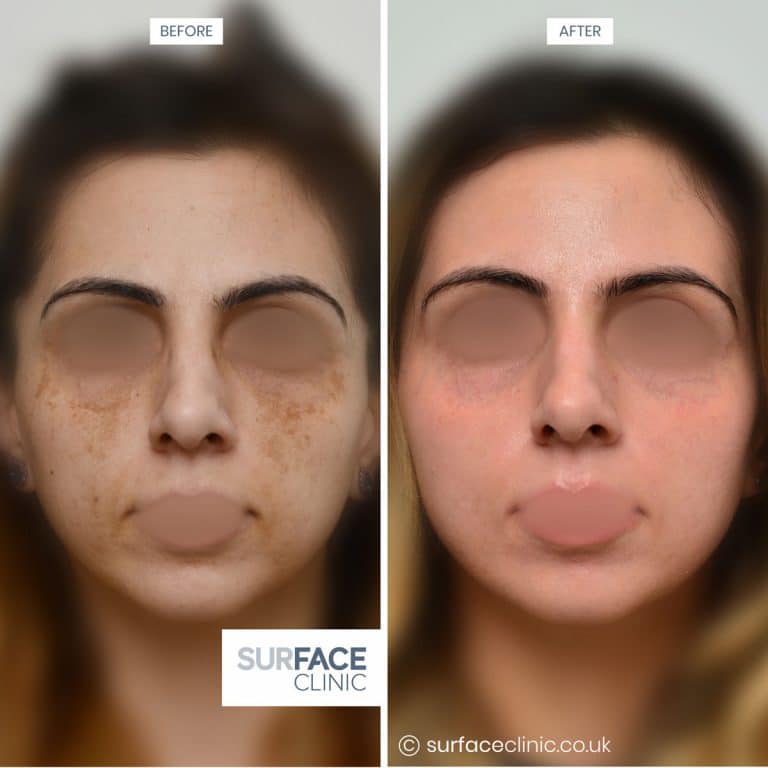 Skin Rejuvenation Result