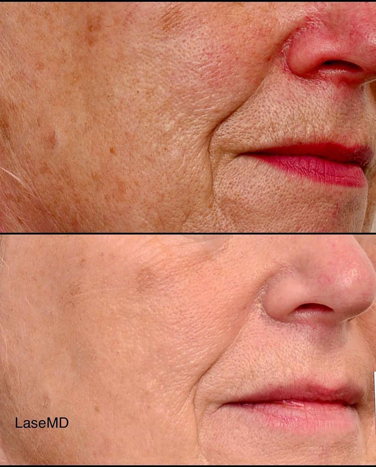 Sun Damage Result
