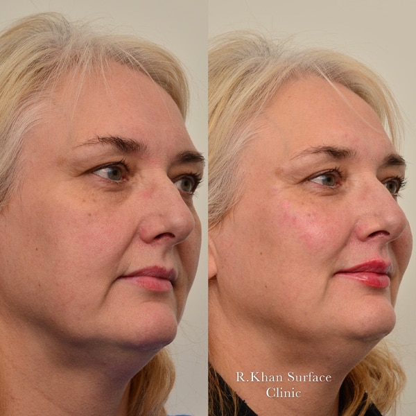 3D Cheek Lift & Volumise Result