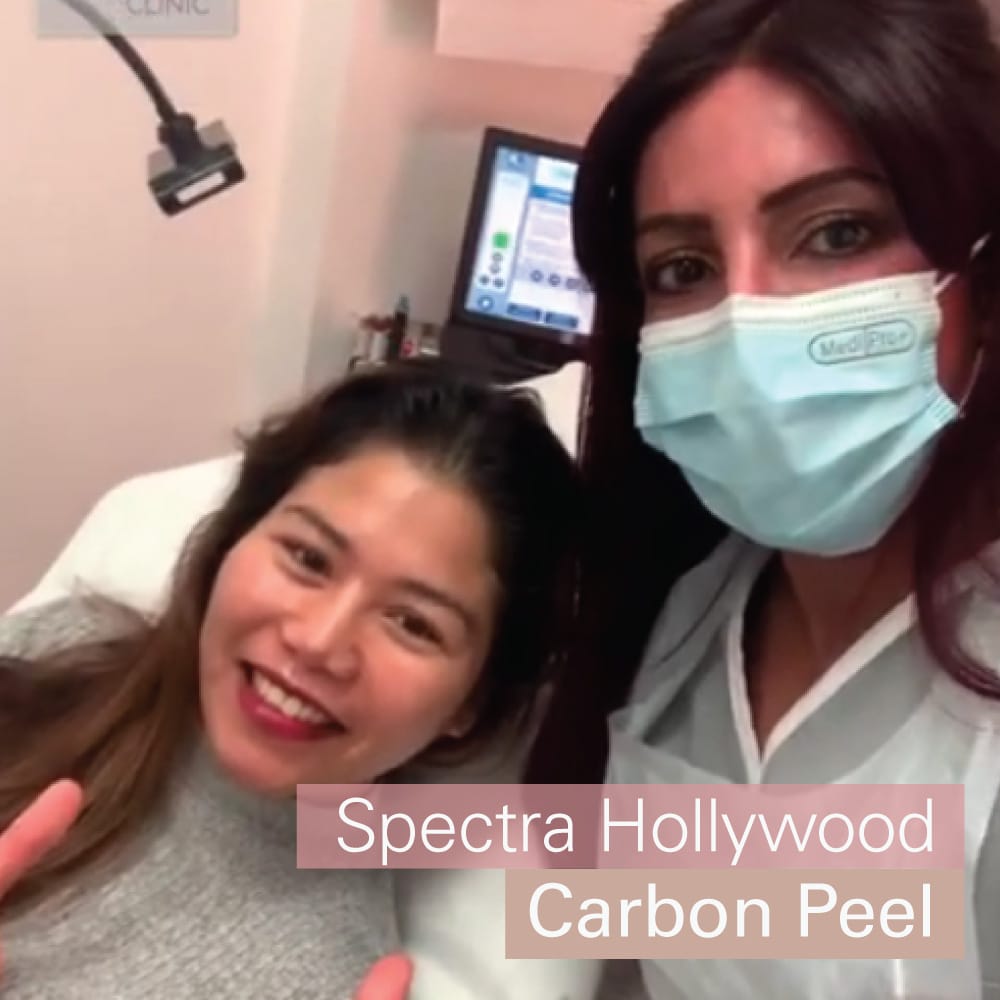 Hollywood carbon peel