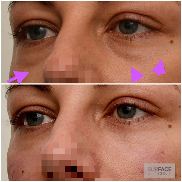 Tear Trough Result