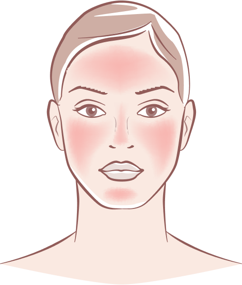 Sun Damage Treatment Bradford