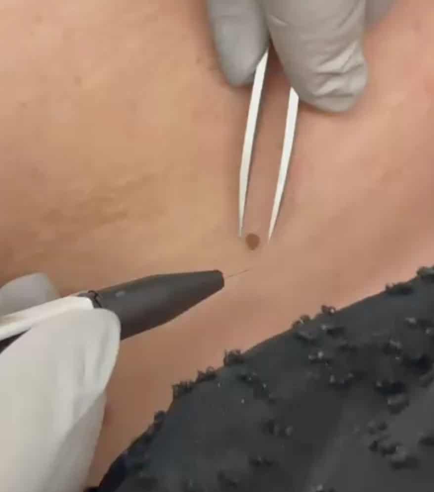 Skin Tag Removal Guiseley